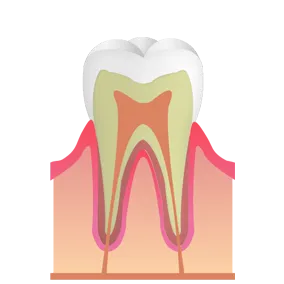 CO：むし歯の初期症状