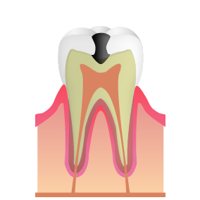 C2：むし歯が象牙質に達した状態