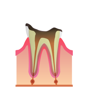 C4：むし歯が歯の根元まで達した状態