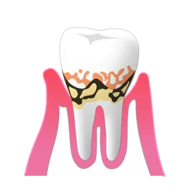 軽度の歯周病